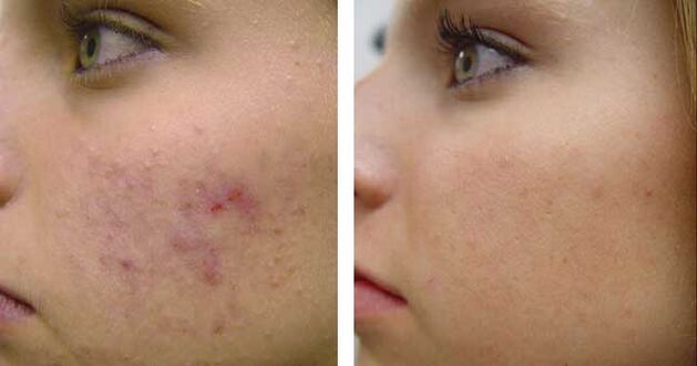 Before and after cryotherapy